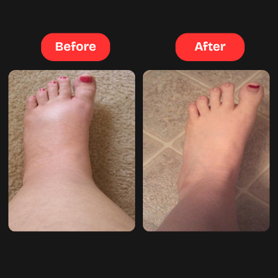 R Alpha Lipoic Acid For neuropathy