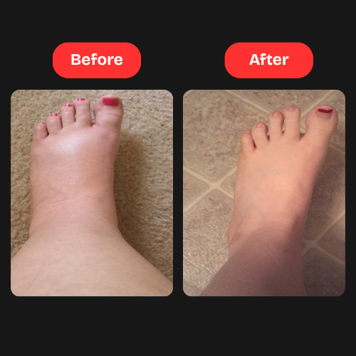 R Alpha Lipoic Acid For neuropathy