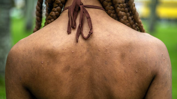 Hyperpigmentation fear